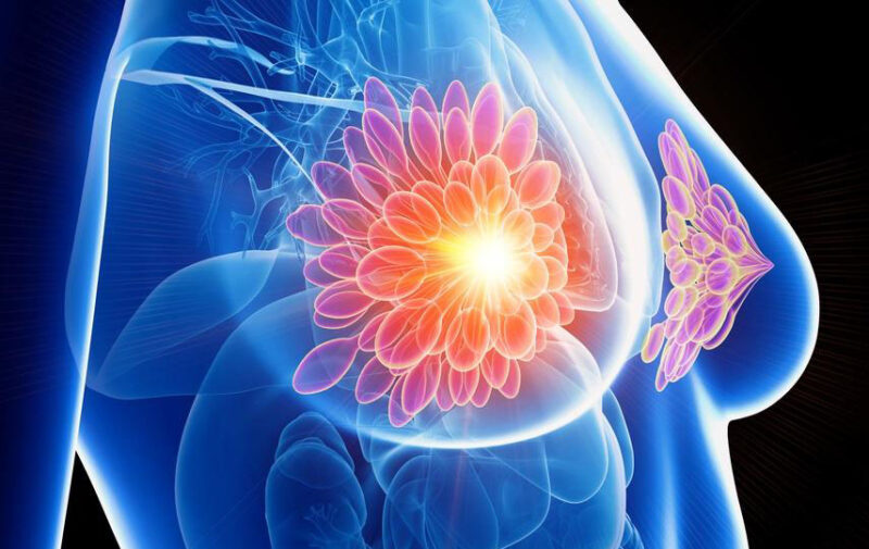 Откриен нов лек кој може да го стопира најсмртоносниот облик на рак на дојка
